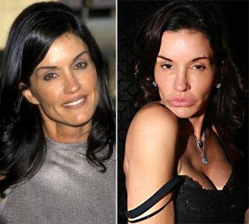 Grandes celebridades antes e depois das plásticas